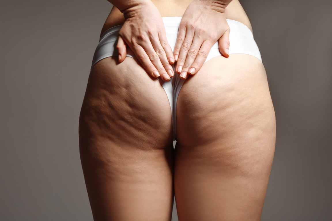 Woman with Cellulite Problem on Dark Background